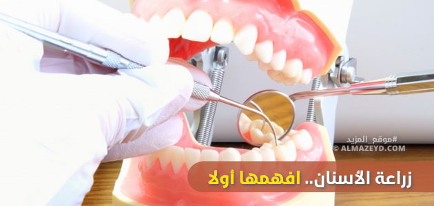 زراعة الأسنان , dental implants