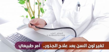 تغير لون السن بعد علاج الجذور.. أمر طبيعي