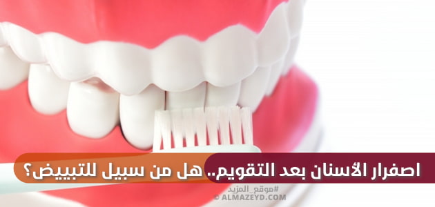 اصفرار الأسنان بعد التقويم.. هل من سبيل للتبييض؟