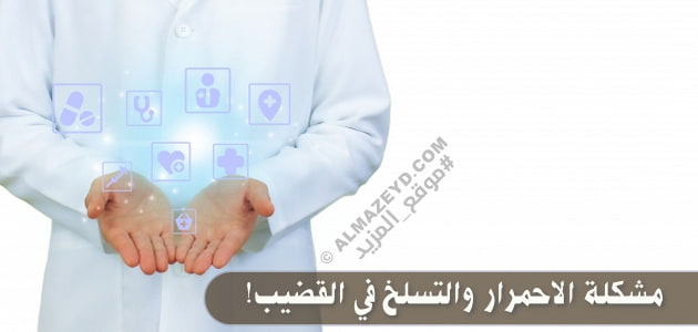 مشكلة الاحمرار والتسلخ في القضيب: صدفية أم أكزيما؟