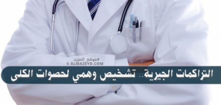 التراكمات الجيرية.. تشخيص وهمي لحصوات الكلى