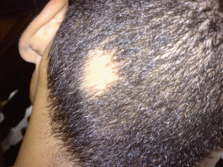 Alopecia , الثعلبة , صورة