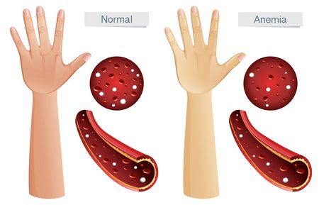 فقر الدم ، Anemia ، الأنيميا ، صورة