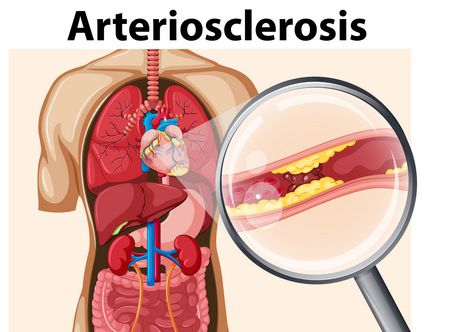 أسباب وعلاج تصلب الشرايين (Arteriosclerosis)