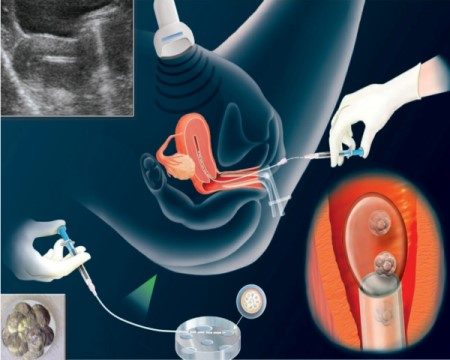 التلقيح الصناعي ، الحقن المجهري ، أطفال الأنابيب ، العقم
