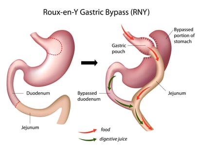 Bariatric Conversion,تحويل مسار المعدة،صورة