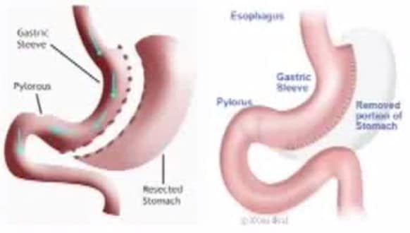 ,جراحات السمنة،العمليات الجراحية, السمنة، علاجات السمنة، تكميم المعدةBariatric surgery,Bariatric surgery،صورة