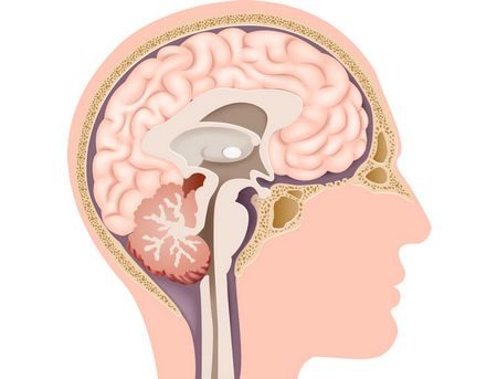 ضمور المخيخ ، Cerebellar atrophy ، مرض ، صورة