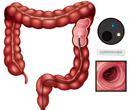 صورة , القولون , تنظير القولون , تهيج القولون