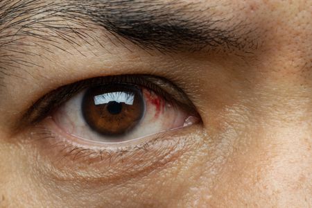 ما هو علاج مرض رمد العين