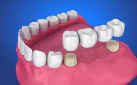 تركيبات الأسنان ، العناية بالأسنان ، التهاب اللثة ، عمليات الأسنان