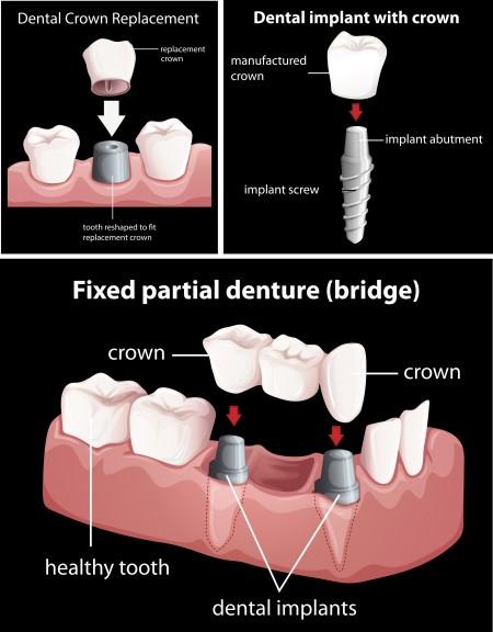 زراعة الأسنان ، العناية بالأسنان ، التهابات اللثة ، نظافة الأسنان