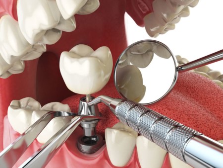 زراعة الأسنان ، عصب الأسنان ، التهابات اللثة