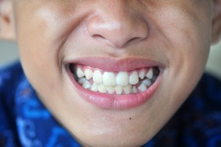 الأسنان اللبنية , Dental teeth , صورة