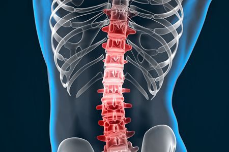أمراض, العمود الفقري, Diseases, the spine , صورة, Backbones