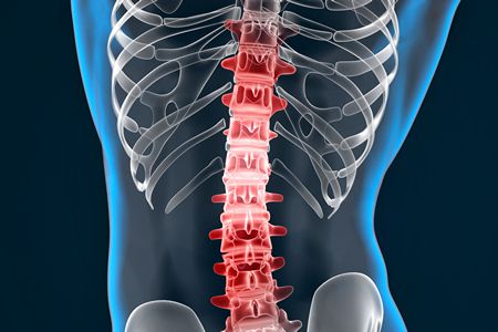 أمراض, العمود الفقري, Diseases, the spine , صورة, Backbones