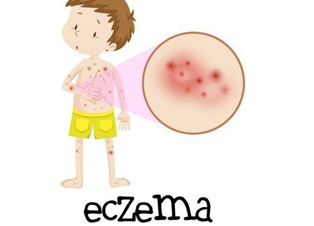 صورة , طفل , الأكزيما , الأمراض الجلدية