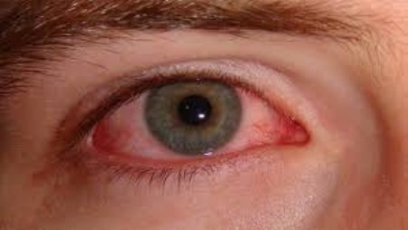 حساسية العين ، الرمد الربيعي ، الحساسية الموسمية ، التهاب الجفون