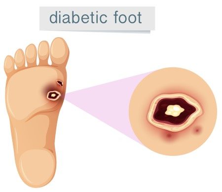 شهرة تطهير دوار  ما هي تروية الأقدام لمرضى القدم السكري - موقع المزيد