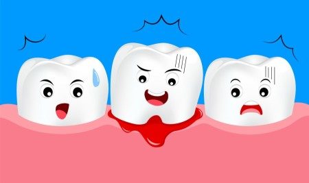 التهاب اللثة ، الأسنان ، مشاكل اللثة ، تسوس الأسنان