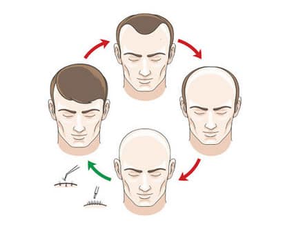 زراعة الشعر،Hair Transplant،صورة