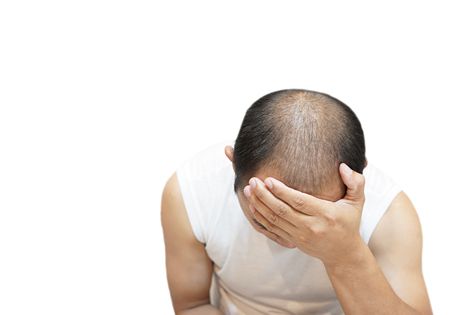 تساقط الشعر, Hair loss , صورة