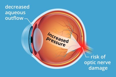 كل ما يتعلق بارتفاع ضغط العين تفصيلاً
