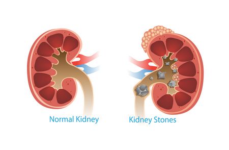 أبرز أسباب حدوث حصوات الكلى مع طرق الوقاية والعلاج