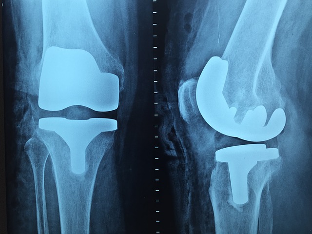 Knee pain،صورة،آلام الركبة،آشعة