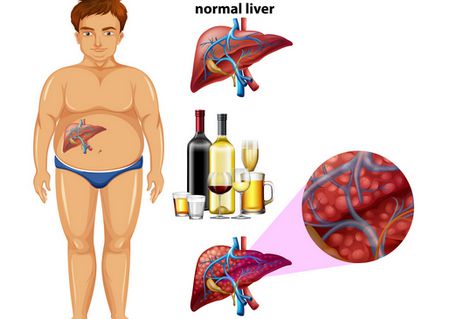 صورة , الكبد , مرض الكبد الوبائي