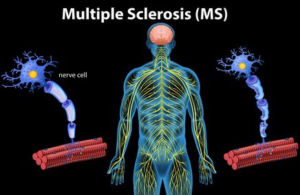 صورة , مرض التصلب المتعدد