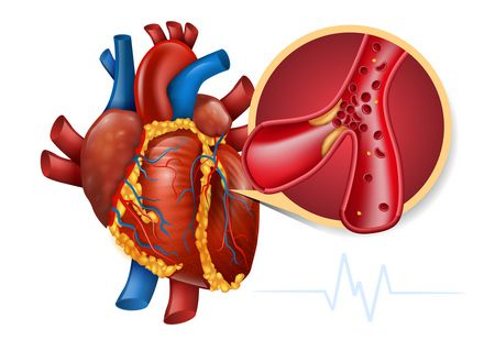 احتشاء عضلة القلب , Myocardial infarction , الجلطات القلبية , التغذية