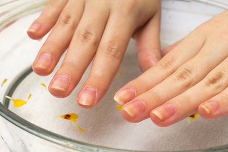 فطريات الأظافر , ظفر , Nail fungus , صورة