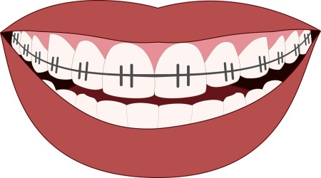 تقويم الأسنان ، الأسنان ، الجراحات التقويمية ، عظام الفكين