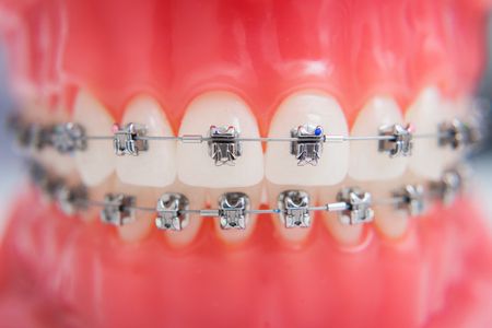 فترة علاج تقويم الأسنان