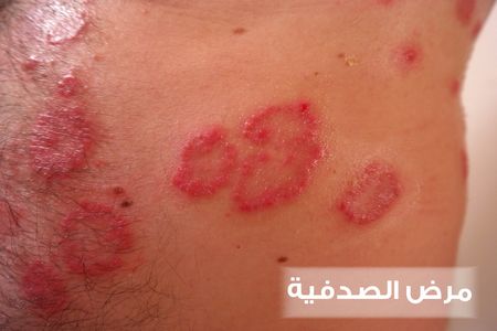 مرض الصدفية , Psoriasis , صورة , أمراض جلدية , الصداف