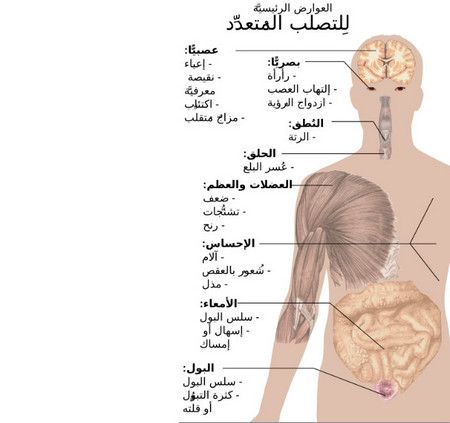 مرض التصلب اللويحي – أعراضه – أسبابه وعلاجه