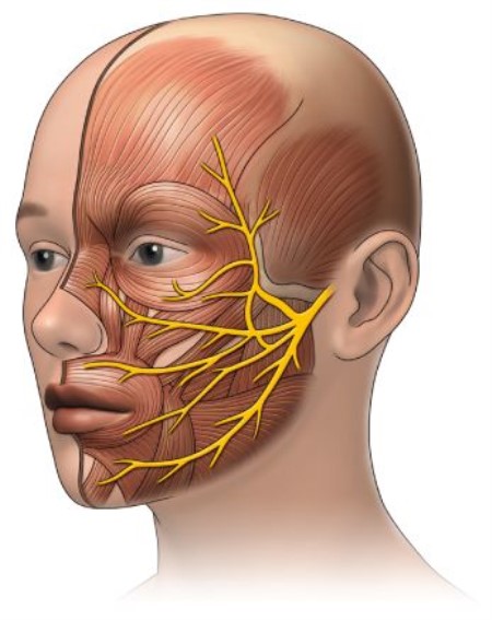 التهاب العصب السابع ، التهاب الأعصاب ، الأذن ، العين ، الشلل