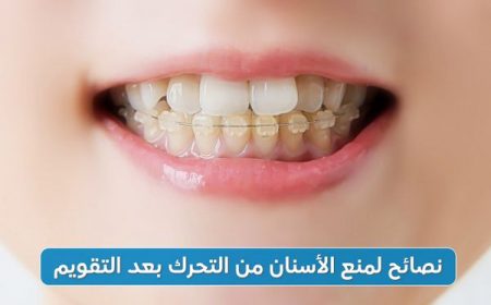 نصائح لمنع الأسنان من التحرك بعد التقويم