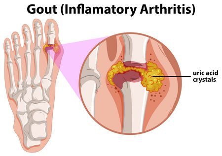 علاج , مرض النقرس , Treatment , gout , صورة