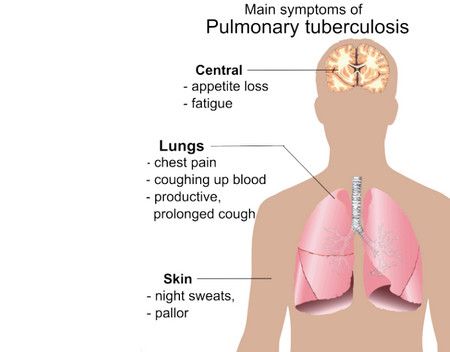 Tuberculosis،السل الرئوي،صورة