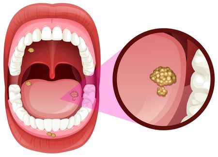 صورة , تقرحات الفم 