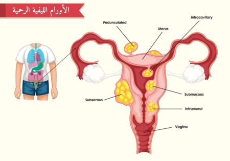 الألياف الرحمية , الأورام الليفية الرحمية, Uterine fibroids