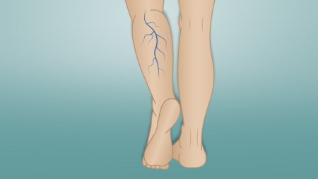 الدوالي ، الارتداد الوريدي ، الأوعية الدموية ، أوردة الساق ، دوالي الساقين