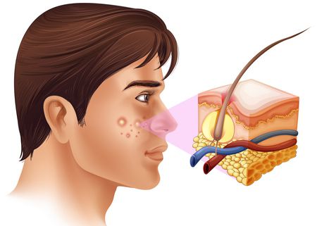 مضاعفات وعلاج حب الشباب