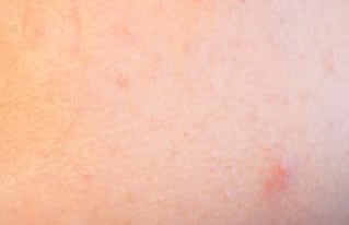 acne،صورة،حب الشباب