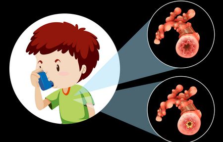 حساسية الصدر ونوبات الربو عند الأطفال