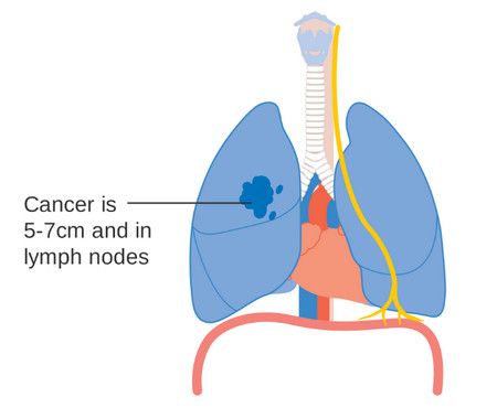 السرطان،cancer،صورة