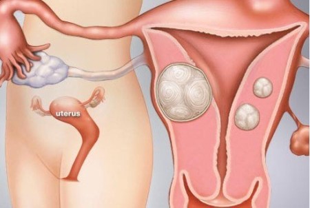 الورم الليفي ، بطانة الرحم ، الدورة الشهرية