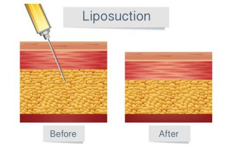 صورة , عملية شفط الدهون , إذابة الدهون